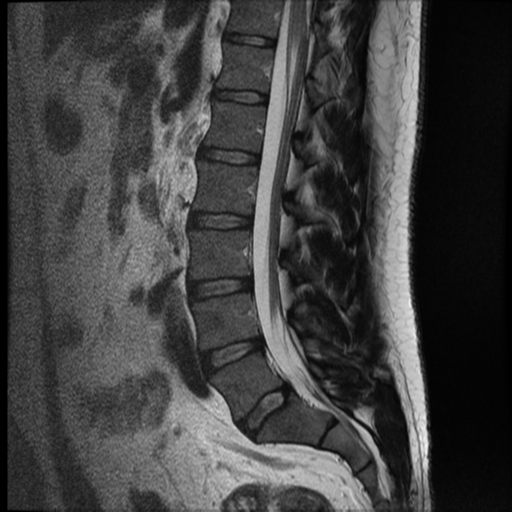 File:Normal lumbar spine MRI (Radiopaedia 35543-37039 Sagittal T2 6).png