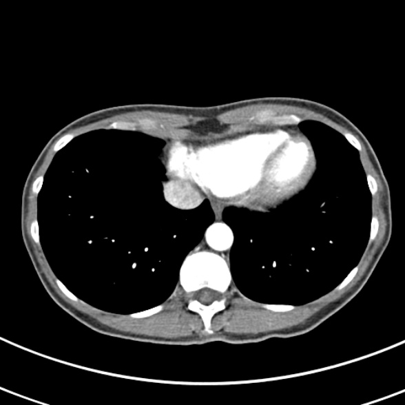 File:Normal multiphase CT liver (Radiopaedia 38026-39996 B 2).jpg