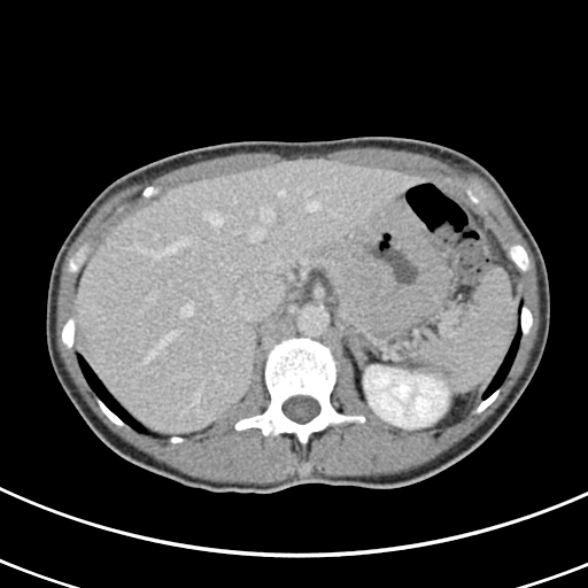 File:Normal multiphase CT liver (Radiopaedia 38026-39996 C 18).jpg
