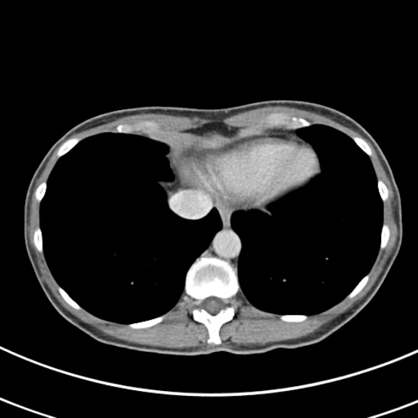 File:Normal multiphase CT liver (Radiopaedia 38026-39996 C 2).jpg