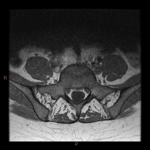 File:Normal spine MRI (Radiopaedia 77323-89408 Axial T1 25).jpg