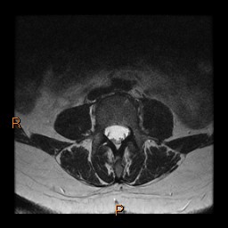 File:Normal spine MRI (Radiopaedia 77323-89408 Axial T2 10).jpg