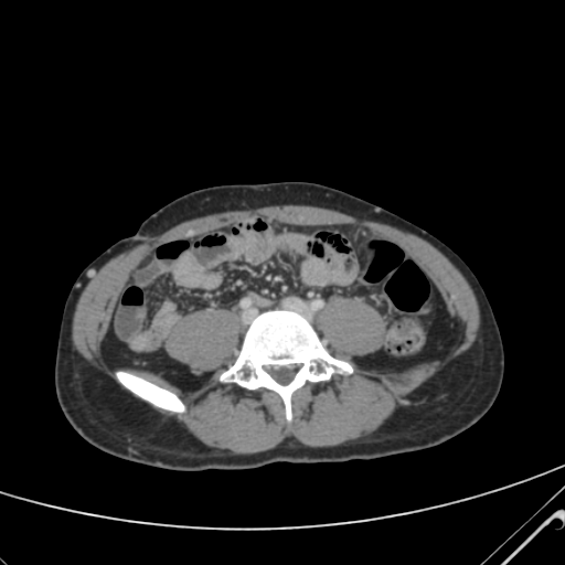 File:Nutmeg liver- Budd-Chiari syndrome (Radiopaedia 46234-50635 B 47).png