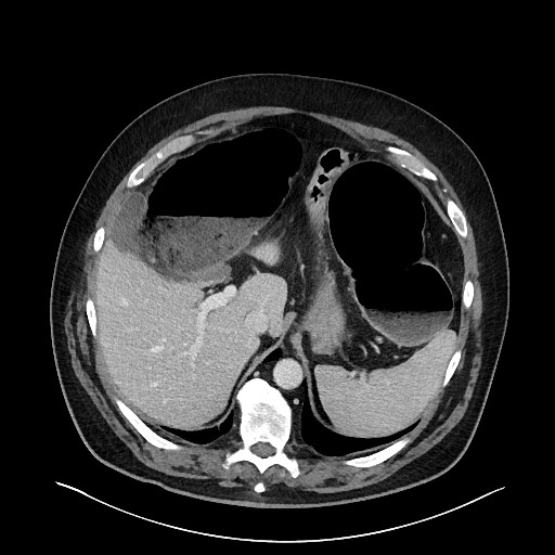 Obstructing sigmoid adenocarcinoma (Radiopaedia 58465-65619 A 38).jpg