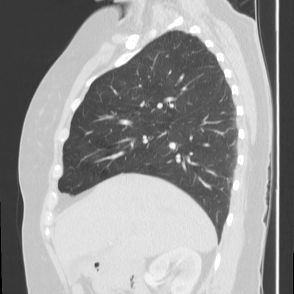 Obstructing typical carcinoid causing bronchoceles (Radiopaedia 50149-55476 Sagittal lung window 19).png