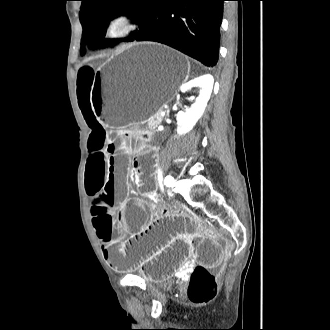 Obturator hernia causing small bowel obstruction (Radiopaedia 65522-74612 C 34).jpg