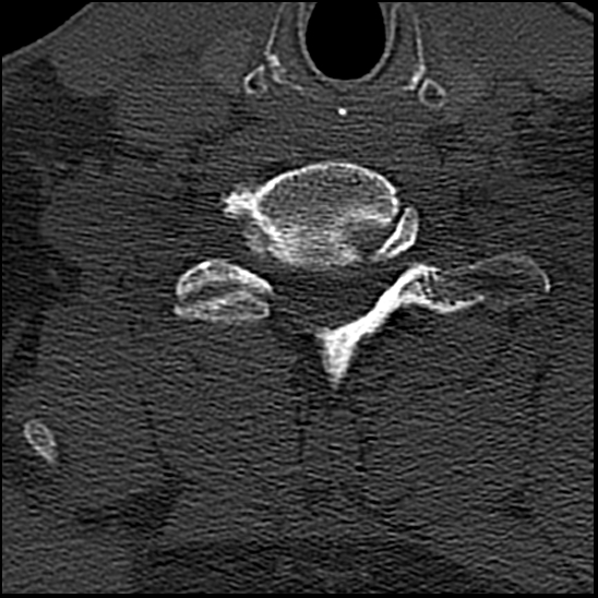Occipital condyle fracture (type 1) (Radiopaedia 87670-104084 Axial bone window 70).jpg