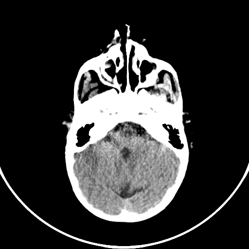 Occipital encephalocele (Radiopaedia 87339-103636 Axial non-contrast 26).jpg