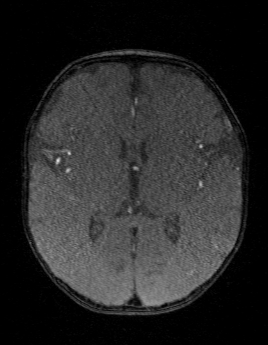Occipital horn syndrome (Radiopaedia 14255-14129 MRA 87).jpg