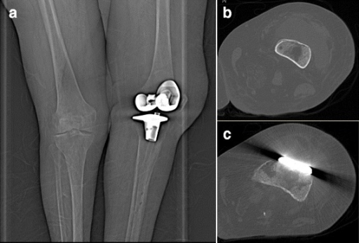 a)Frontal radiograph of the left knee demonstrates normal post-operative appearance of prosthesis with no prosthetic loosening b,c) computer tomography shows an abscess in front of knee prosthesis caused by Pasteurella multocida
