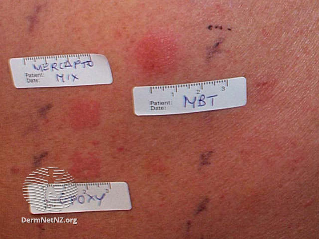File:Patch tests (DermNet NZ dermatitis-pt-epoxy).jpg