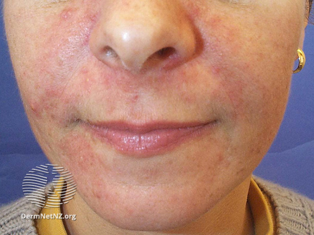 Rosacea (DermNet NZ acne-red-face-3609).jpg