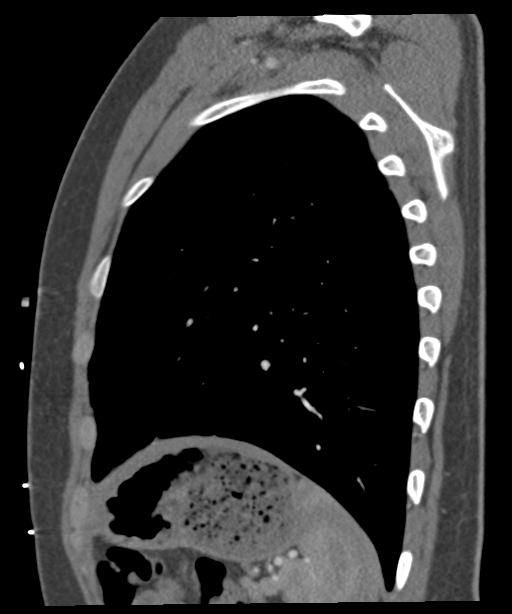 'Bovine' aortic arch (Radiopaedia 33554-34637 B 6).png