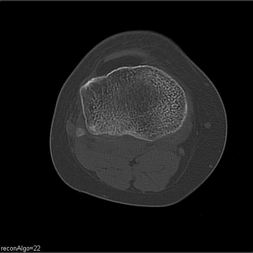File:ACL avulsion fracture (Radiopaedia 33833-34994 Axial bone window 20).jpg