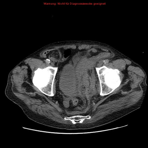 Abdominal aortic aneurysm- extremely large, ruptured (Radiopaedia 19882-19921 Axial C+ arterial phase 71).jpg