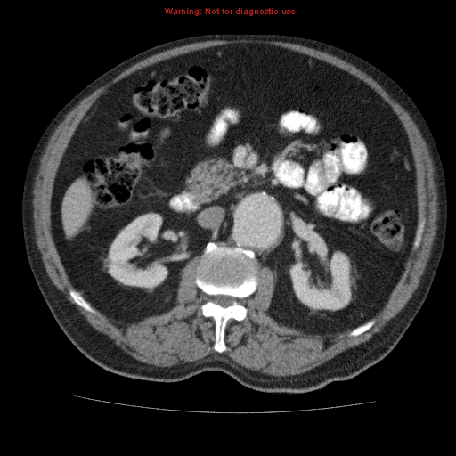 Abdominal aortic aneurysm (Radiopaedia 10122-10660 Axial C+ portal venous phase 31).jpg