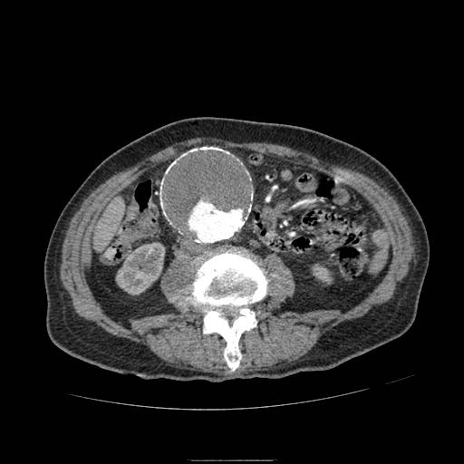 Abdominal aortic aneurysm (Radiopaedia 13341-13340 Axial C+ arterial phase 111).jpg