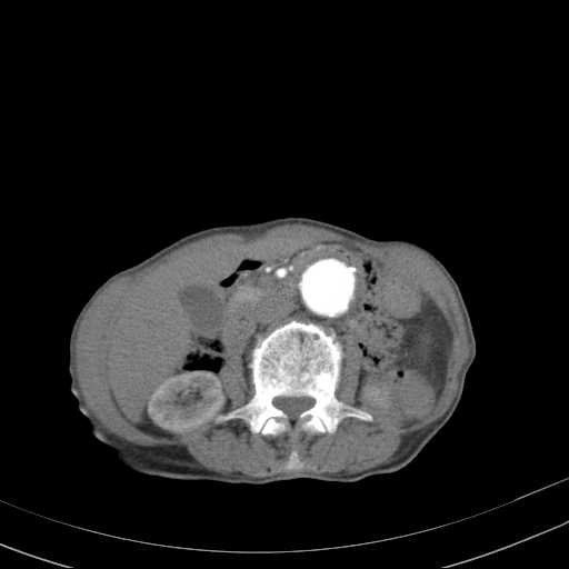 File:Abdominal aortic aneurysm (Radiopaedia 20827-20742 Axial C+ arterial phase 16).jpg