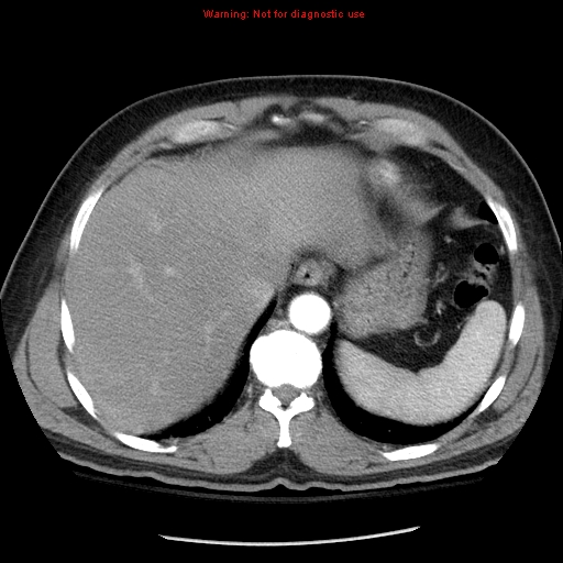 File:Abdominal aortic aneurysm (Radiopaedia 8190-9038 Axial C+ arterial phase 11).jpg