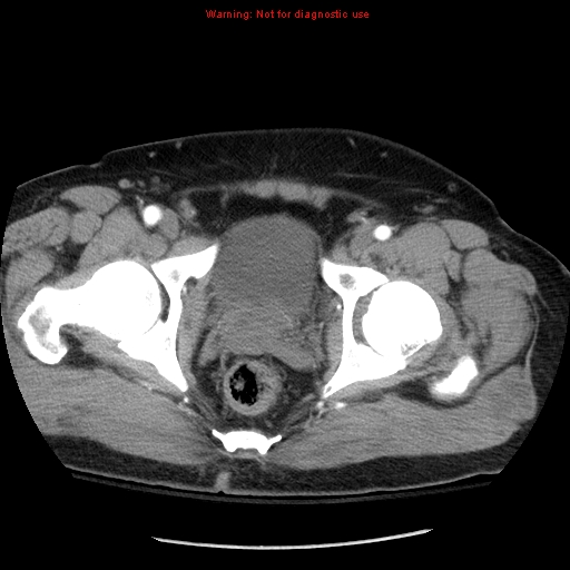 Abdominal aortic aneurysm (Radiopaedia 8190-9038 Axial C+ arterial phase 80).jpg