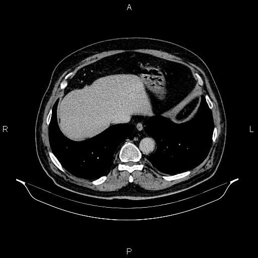 Abdominal aortic aneurysm (Radiopaedia 83094-97462 Axial renal excretory phase 16).jpg