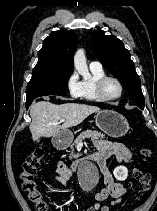 Abdominal aortic aneurysm (Radiopaedia 83094-97462 Coronal renal cortical phase 35).jpg