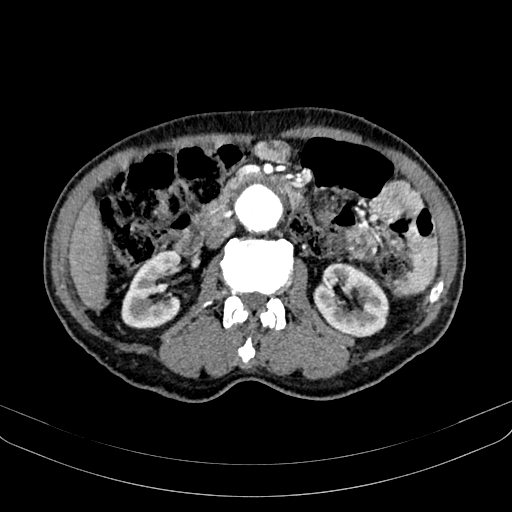 Abdominal aortic aneurysm (Radiopaedia 83581-98689 Axial C+ arterial phase 55).jpg