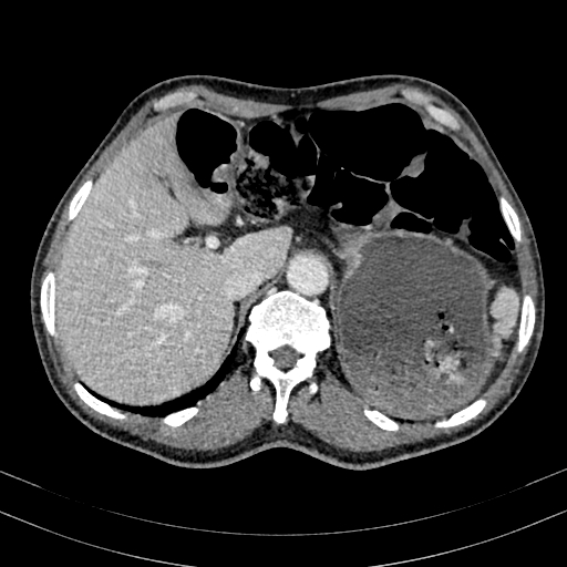 Abdominal aortic aneurysm (Radiopaedia 83581-98689 Axial C+ portal venous phase 24).jpg