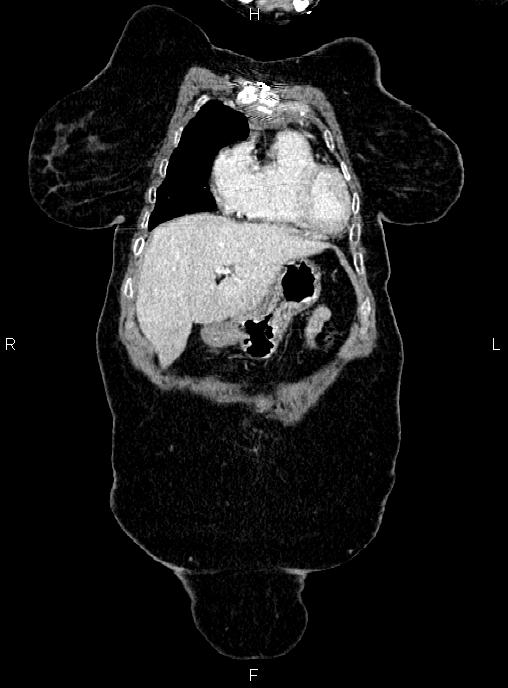 Abdominal aortic aneurysm (Radiopaedia 85063-100606 Coronal C+ arterial phase 4).jpg