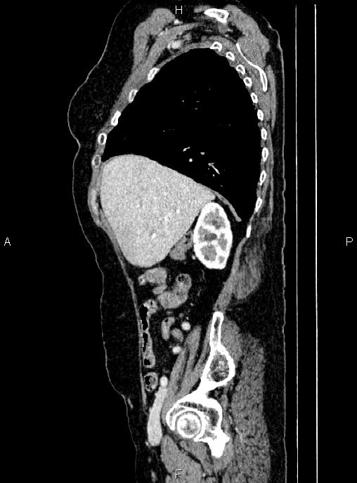 Abdominal aortic aneurysm (Radiopaedia 85063-100606 Sagittal C+ arterial phase 19).jpg