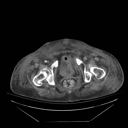 Abdominal aortic aneurysm - impending rupture (Radiopaedia 19233-19247 Axial non-contrast 161).jpg