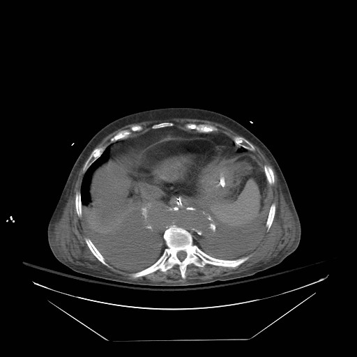 Abdominal aortic aneurysm - impending rupture (Radiopaedia 19233-19247 Axial non-contrast 29).jpg