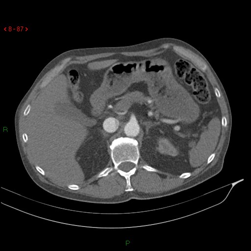 File:Abdominal aortic aneurysm rupture with aortocaval fistula (Radiopaedia 14897-14841 Axial C+ arterial phase 87).jpg