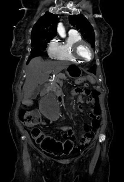 Abdominal aortic aneurysm with thrombus fissuration (Radiopaedia 73192-83919 Coronal C+ arterial phase 16).jpg