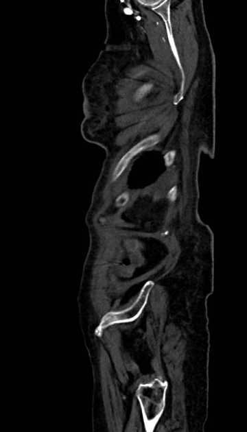 Abdominal aortic aneurysm with thrombus fissuration (Radiopaedia 73192-83919 Sagittal C+ arterial phase 4).jpg