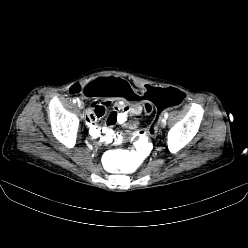 File:Abdominal collection due to previous cecal perforation (Radiopaedia 80831-94320 Axial C+ portal venous phase 176).jpg