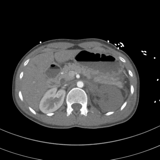 File:Abdominal multi-trauma - devascularised kidney and liver, spleen and pancreatic lacerations (Radiopaedia 34984-36486 Axial C+ arterial phase 100).png