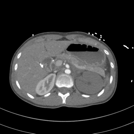 Abdominal multi-trauma - devascularised kidney and liver, spleen and pancreatic lacerations (Radiopaedia 34984-36486 Axial C+ arterial phase 96).png
