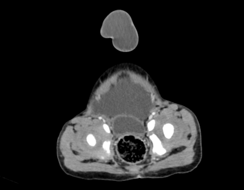 Abdominal premesenteric cystic lymphangioma (Radiopaedia 82995-97350 Axial C+ portal venous phase 62).jpg