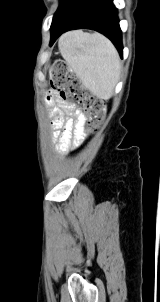 Abdominal wall and retroperitoneal tuberculosis (Radiopaedia 88137-104729 Sagittal C+ portal venous phase 23).jpg