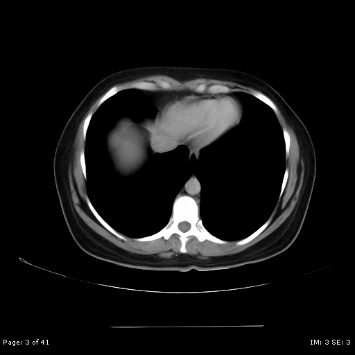 File:Abdominal wall endometriosis (Radiopaedia 25723-25885 Axial C+ portal venous phase 3).jpg
