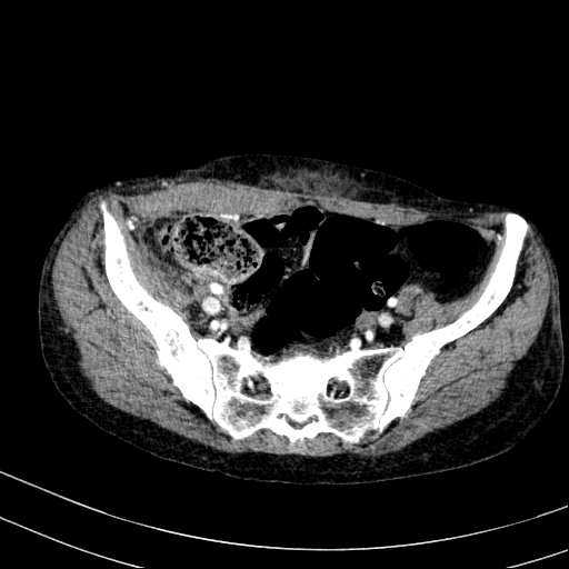 Abdominal wall hematoma with active bleeding (Radiopaedia 83915-99117 Axial renal cortical phase 106).jpg