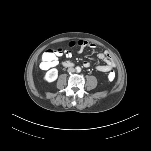 File:Abdominal wall metastasis from colorectal carcinoma (Radiopaedia 31016-31717 Coronal C+ portal venous phase 1).jpg