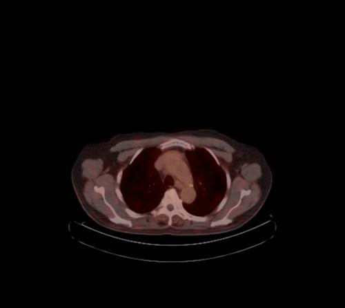 File:Abdominal wall metastasis from colorectal carcinoma (Radiopaedia 31016-31719 C 117).jpg