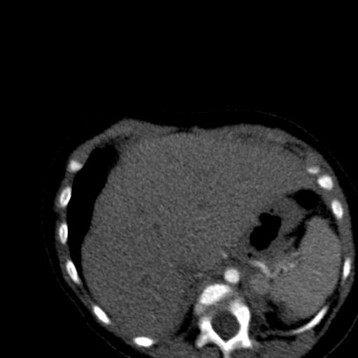 File:Aberrant left pulmonary artery (pulmonary sling) (Radiopaedia 42323-45435 Axial C+ CTPA 44).jpg