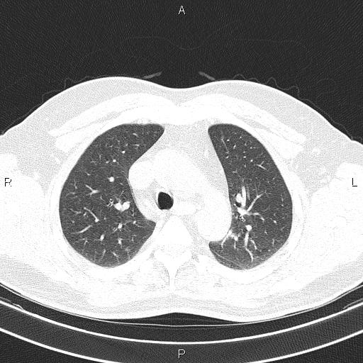 Aberrant right subclavian artery (Radiopaedia 87093-103354 Axial lung window 34).jpg