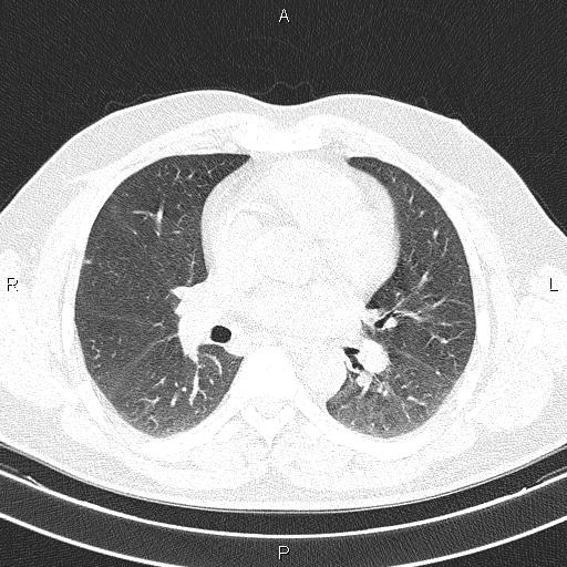 File:Aberrant right subclavian artery (Radiopaedia 87093-103354 Axial lung window 56).jpg