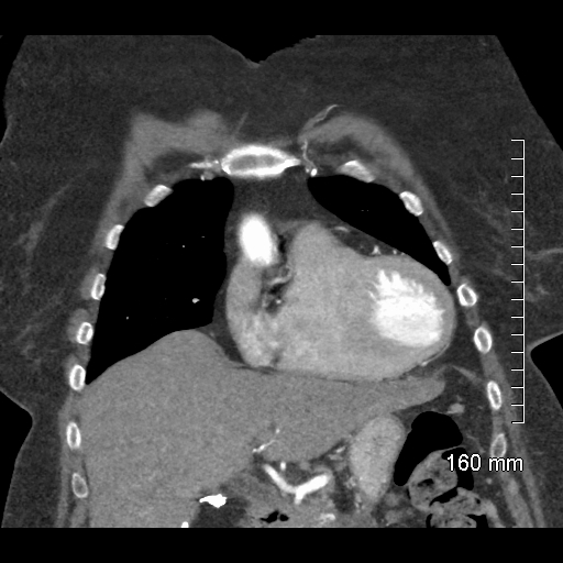 Aberrant right subclavian artery stenosis (Radiopaedia 52656-58670 B 28).jpg