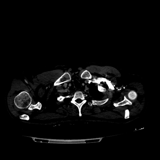 File:Accesory rib joint (Radiopaedia 71987-82452 Axial bone window 91).jpg