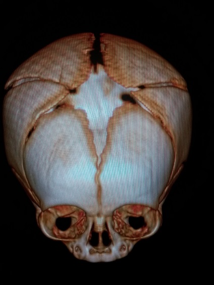File:Accessory intraparietal suture (Radiopaedia 50584-56021 3D reconstruction 7).jpg